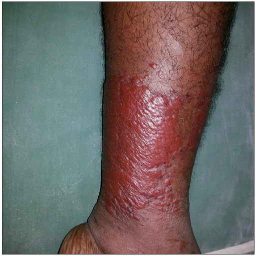 Mimickers of erysipelas and cellulitis: A narrative review