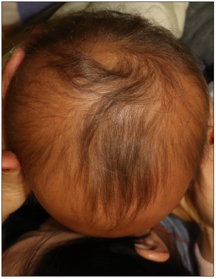 Hereditary hypotrichosis simplex with SNRPE gene mutation