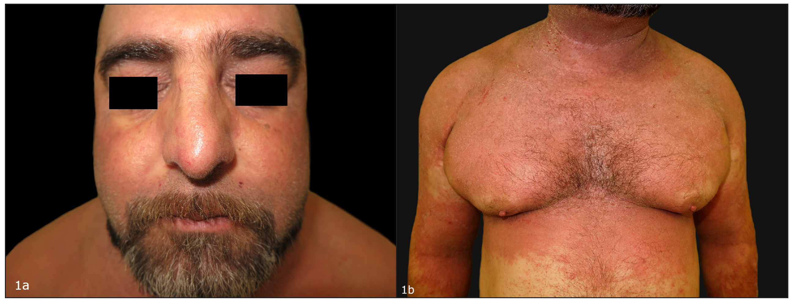 Erythrodermic atopic dermatitis responding to tralokinumab after dupilumab failure