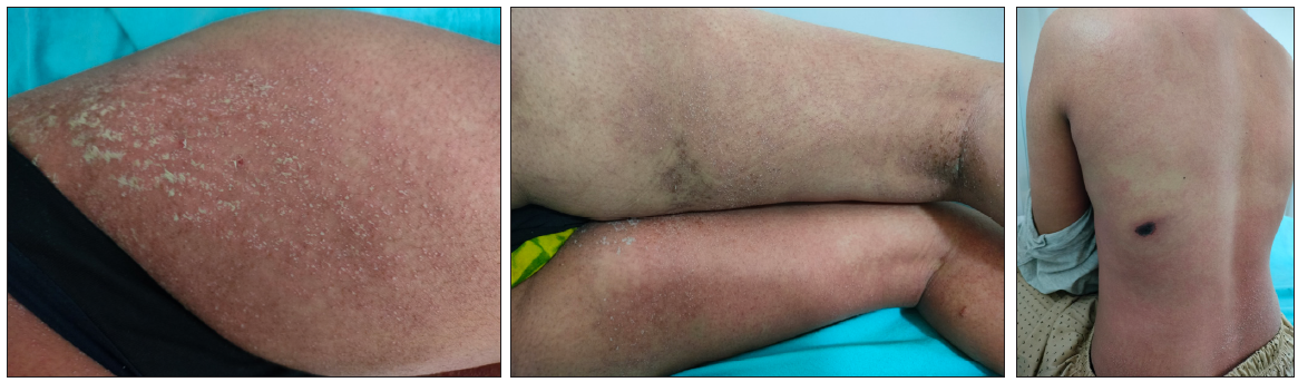 Acute generalised exanthematous pustulosis secondary to spider bite