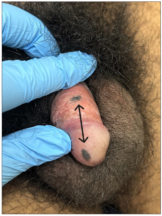 Kissing lesions in dermatology