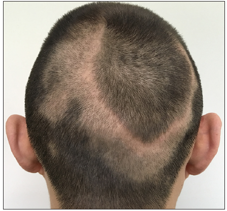 Linear and annular lupus panniculitis of the scalp