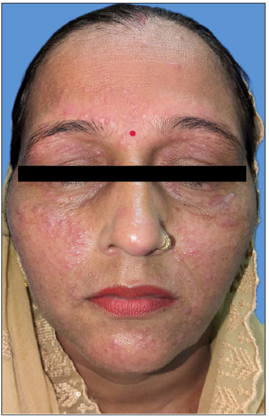 Successful use of topical ivermectin in the treatment and maintenance of lupus miliaris disseminatus faciei