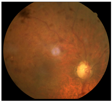 Acute painless loss of vision due to bilateral hemiretinal vein occlusion in a case of bullous pemphigoid on tofacitinib: A potentially red flag symptom