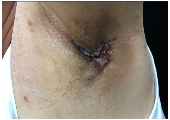 Primary carcinoma of accessory breast presenting as axillary ulcer