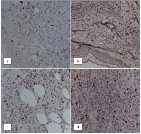 A study of T regulatory cells in type 1 and type 2 leprosy reactions