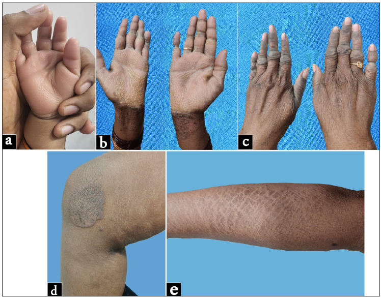 Palmoplantar keratoderma with honeycombing: A case of loricrin keratoderma with heterozygous frameshift mutation in LOR gene, from India