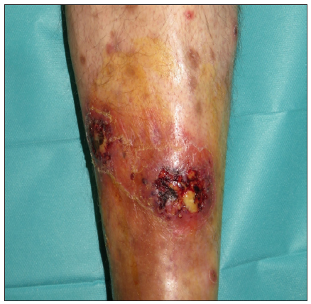 Multifocal pyoderma gangrenosum induced by secukinumab in a patient with hidradenitis suppurativa