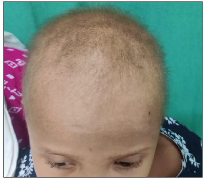 Hypotrichosis simplex type 7: A rare cause of non-syndromic woolly hair