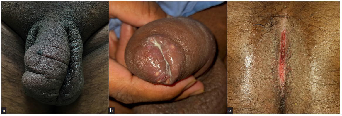 Penile enlargement and ulcers in cutaneous Crohn’s disease