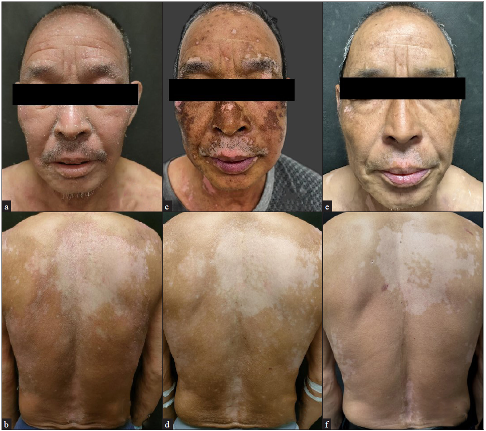 Ritlecitinib rescues exacerbated vitiligo during the JAK1 inhibitor therapy: More than a coincidence?