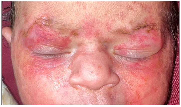 Neonatal lupus erythematosus presenting as raccoon eyes