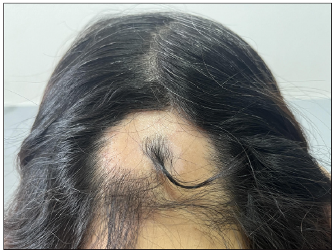 Alopecia areata sparing vitiligo: Another Renbök phenomenon