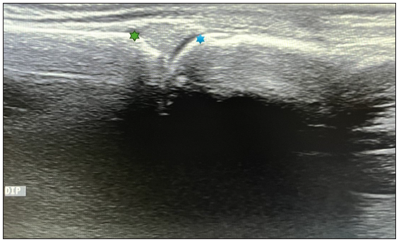 High-frequency ultrasonography for the detection of subclinical arthritis in chronic plaque psoriasis patients – A cross-sectional study