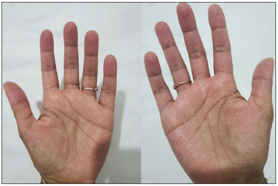 Hunan hand syndrome managed in the intensive care unit