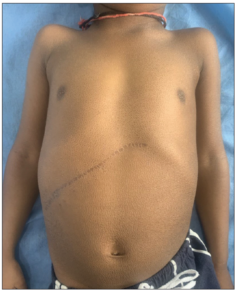 Unveiling a novel gene mutation in neonatal ichthyosis-sclerosing cholangitis syndrome with progressive liver disease