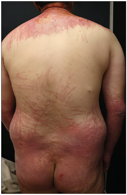 Flagellate erythema: A rare presentation of idiopathic dermatomyositis