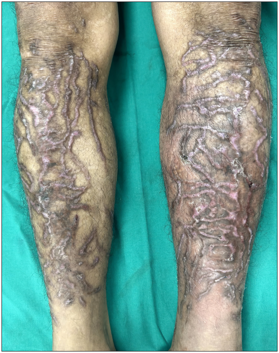 A rare serpiginous pattern of epidermolysis bullosa pruriginosa