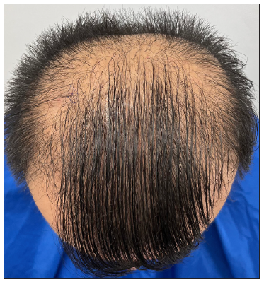 Tofacitinib for fibrosing alopecia in a pattern distribution