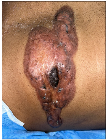 Secondary trichostasis spinulosa in a chest keloid