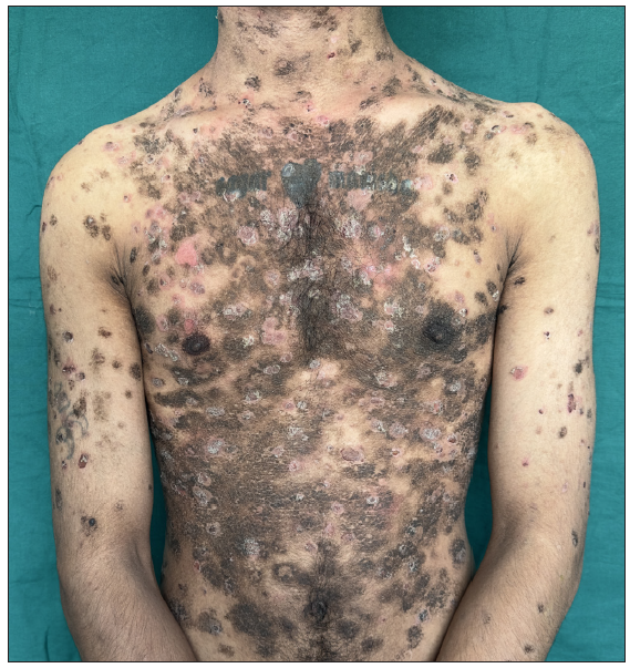 Post pemphigus acanthomata: Revisiting an uncommon presentation of pemphigus