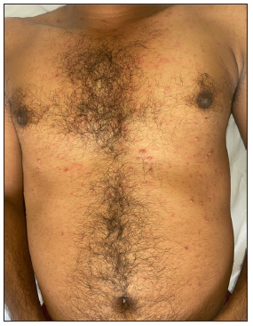 Clustering of varicella over active superficial dermatophytosis: An underreported co-existence