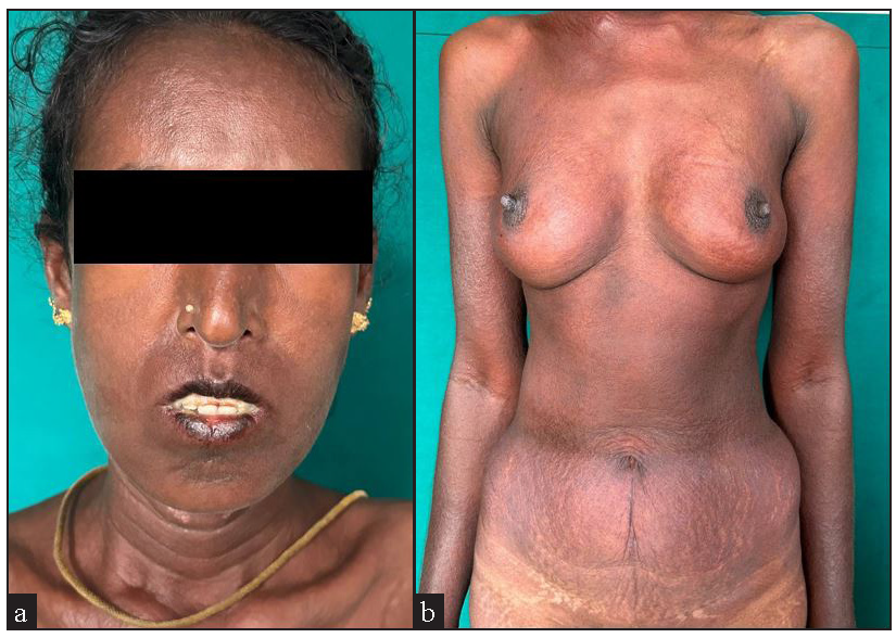 Drug reaction with eosinophilia and systemic symptoms with toxic epidermal necrolysis like rash in systemic sclerosis and overlapping sjogren’s syndrome: A double trouble triggered by a herbal medicine