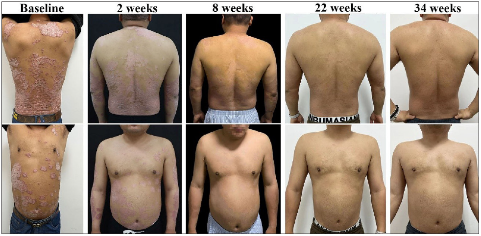 Guselkumab for psoriasis management in an HIV positive patient