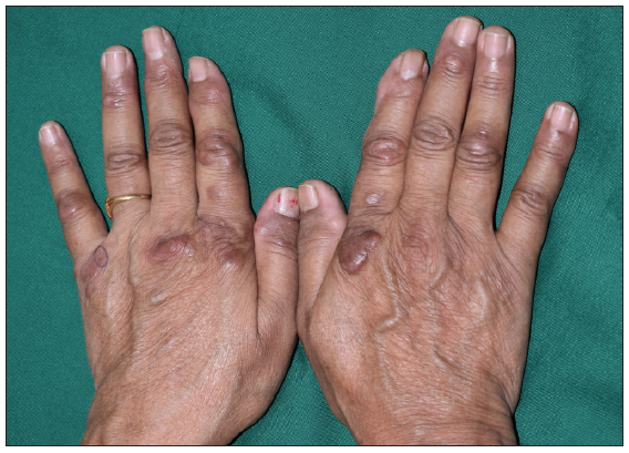 Tender juxta-articular and acral nodules with arthralgias