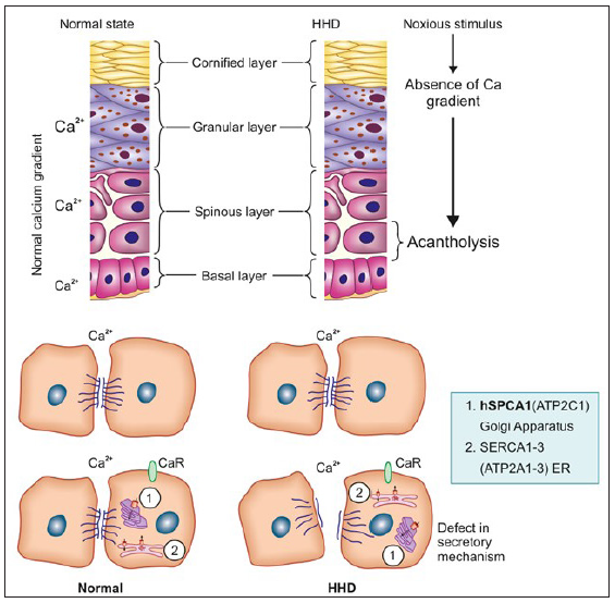 Therapeutic agents for Hailey-Hailey disease: A narrative review