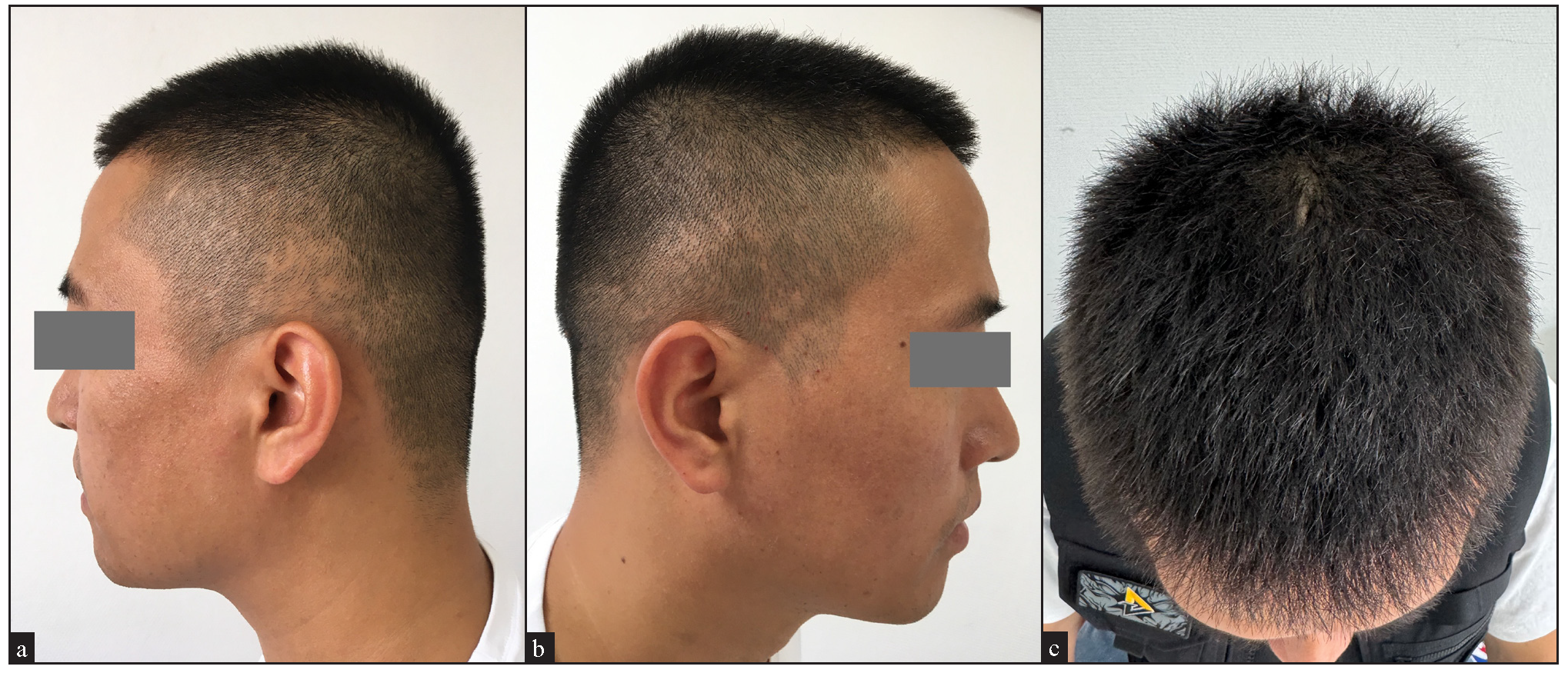 Bilateral temporal alopecia in male androgenetic alopecia: An unusual new presentation