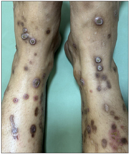 A challenging case of Kyrle’s disease successfully treated with apremilast