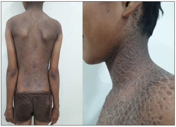 Bathing-suit ichthyosis: A rare but valuable entity for developing personalised pathogenesis-based therapies for autosomal recessive congenital ichthyosis