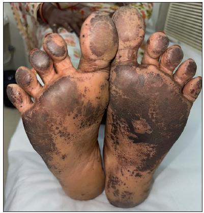 Irritant contact dermatitis to electoral ink: A series of 12 patients