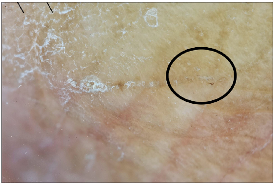 The ‘ball sign’ in UV dermoscopy of scabies