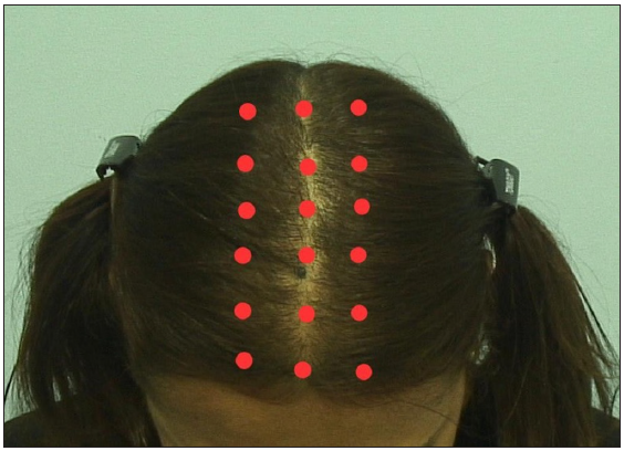 Mesotherapy with bicalutamide for female pattern hair loss