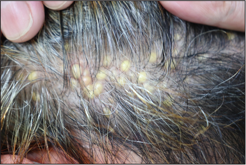 A patient with multiple asymptomatic yellow papules on the scalp