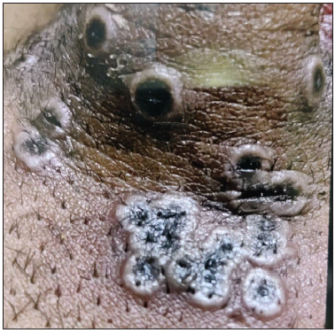 Monkeypox disease in India: Unusual clinical presentation
