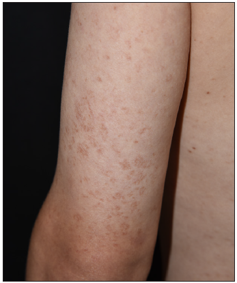 Clinical characteristics of 81 patients with maculopapular cutaneous mastocytosis: A 10-year experience