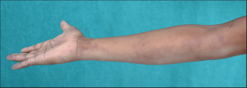 Inadvertent intra-arterial injection: Cutaneous complications and management