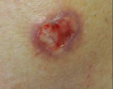 Squamoid eccrine ductal carcinoma: A frequently misdiagnosed entity