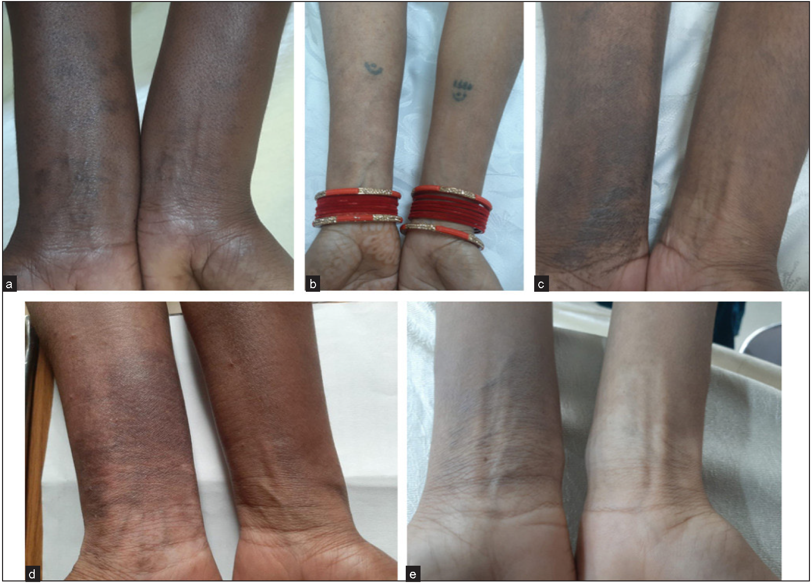 Acquired dermal macular hyperpigmentation secondary to bangles – an unusual encounter