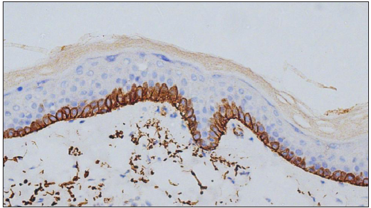 Role of C4d immunohistochemical marker in the diagnosis of bullous pemphigoid: A cross-sectional study