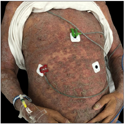 Paradoxical psoriasis induced by IL-17 antagonists