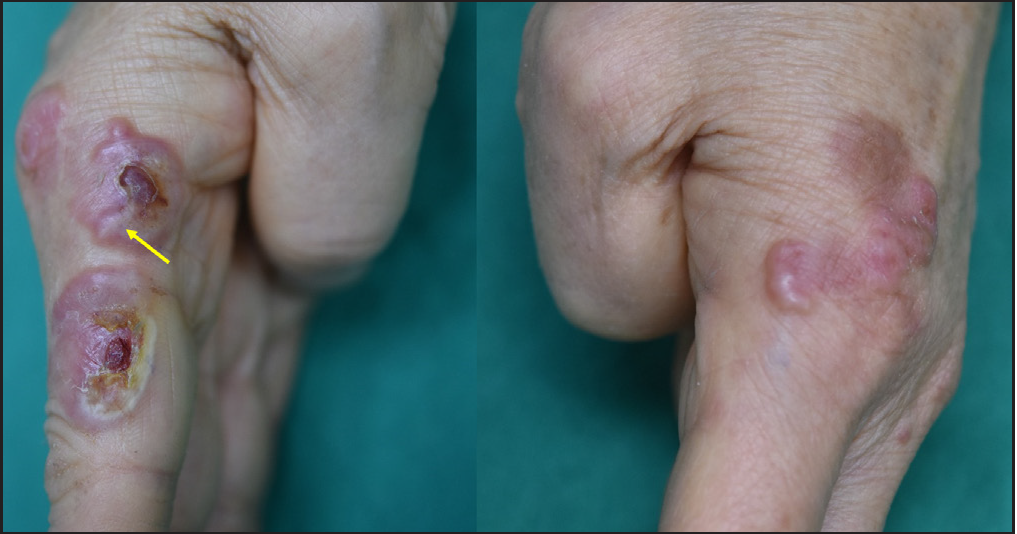 A case of neutrophilic dermatosis of the hands associated with chronic myelomonocytic leukemia presenting as annular papules and plaques