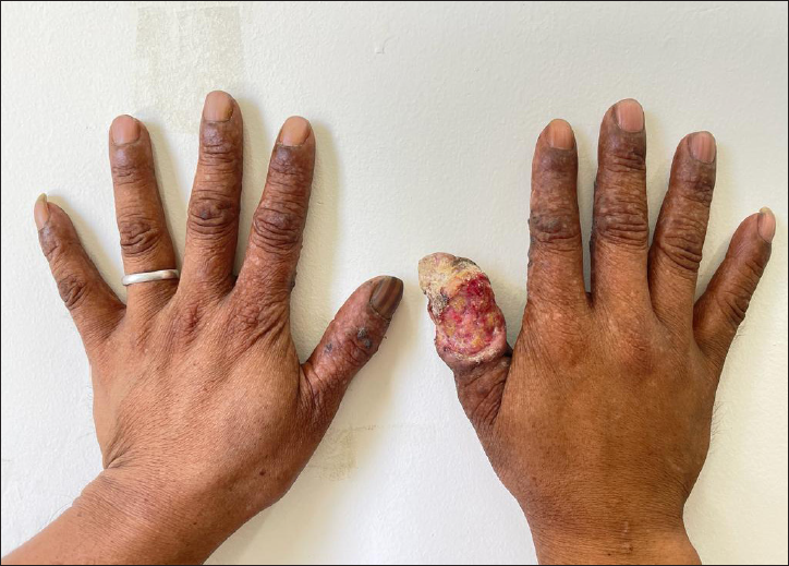 Synergistic effect of long-standing exposure to X-ray and developer solution in the causation of squamous cell carcinoma of right thumb: A case report