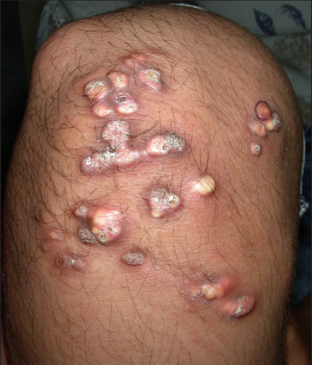 Traumatic dystrophic calcinosis cutis in a child successfully treated with sodium metabisulfite ointment