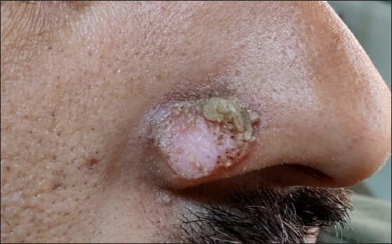 Focal actinic porokeratosis over nose successfully treated with topical tacrolimus