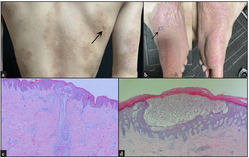 A case of palmoplantar pustulosis with atopic dermatitis: Baricitinib is a safe and effective treatment