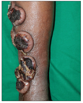 Linear nodulo-ulcerative lesions on the leg in an elderly male